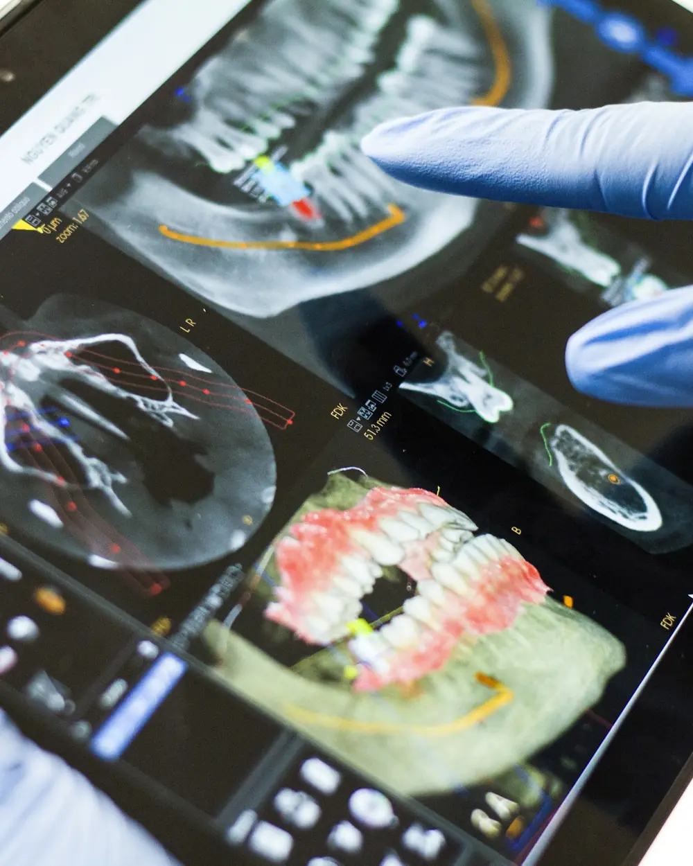 Scansione 3D della bocca su un tablet